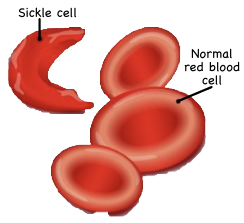 Sickle and normal red blood cells